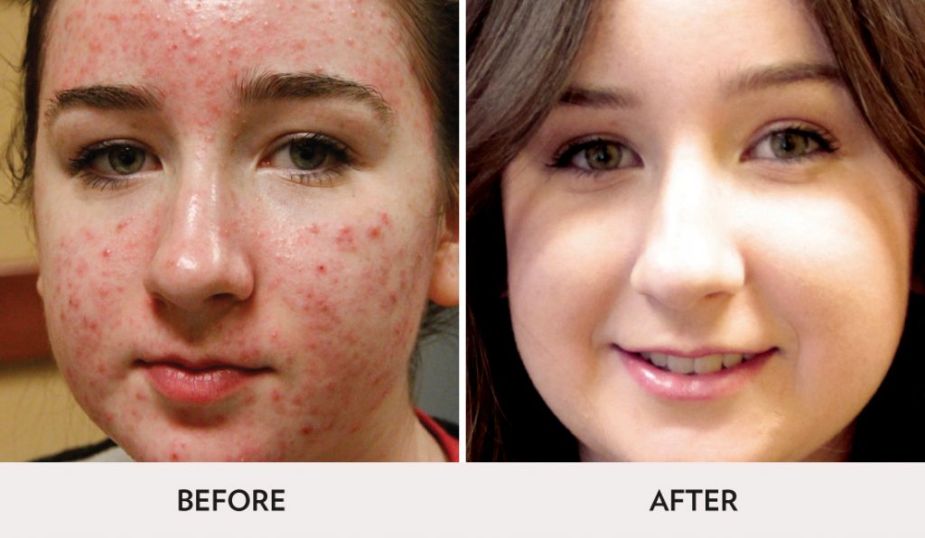 Laser Treatment for Acne and Scar Removal | Spa Radiance Medical